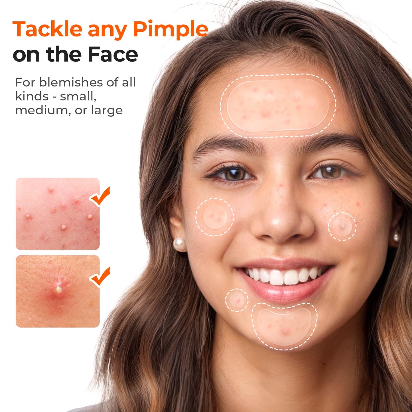 TKTK Chin Pimple Patches (100 Count 6 Sizes), XL Contoured Hydrocolloid Chin Patch 62x42 mm, Large Acne Patch for Face Blemishes Zit Breakouts, Maximum Absorption Overnight Stickers
