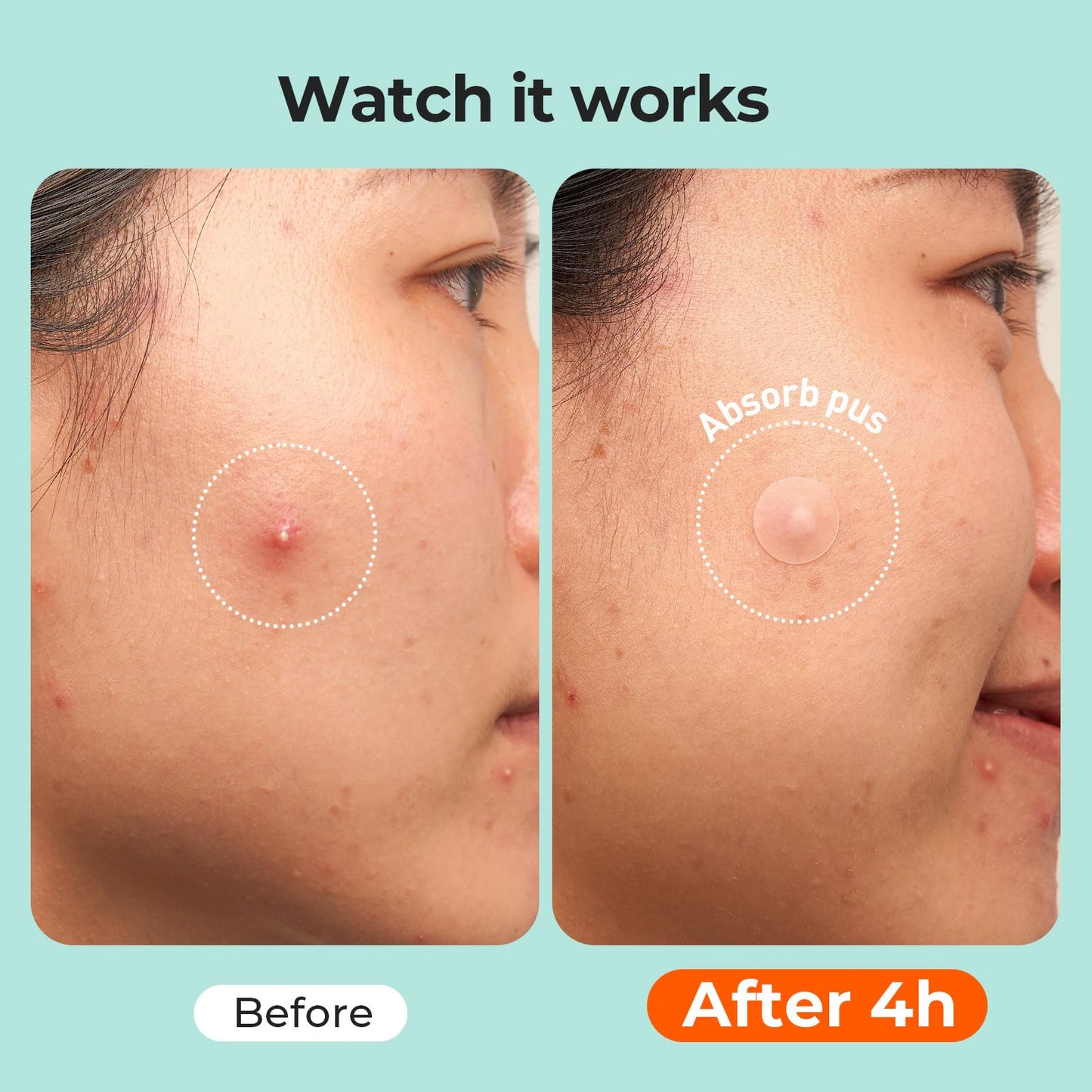 TKTK Chin Pimple Patches (100 Count 6 Sizes), XL Contoured Hydrocolloid Chin Patch 62x42 mm, Large Acne Patch for Face Blemishes Zit Breakouts, Maximum Absorption Overnight Stickers